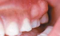 علل آبسه دندان وراه درمان آن