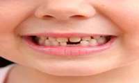 پنج سوالی که درباره دندان شیری می‌پرسند