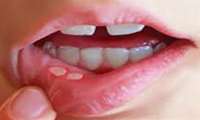 زخم‌های دهانی بیشتر از سه هفته را جدی بگیرید