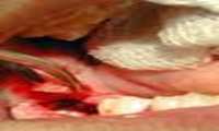 راههای انتقال عفونت در دندانپزشکی