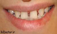 روشهای از بین بردن فاصله بین دندانی