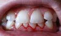 درمان نکردن جرم دندان، بافت لثه را از بین می‌برد