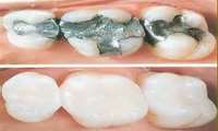 مراقبت‌های لازم بعد از ترمیم (پرکردن) دندان